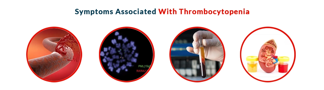 Symptoms Associated With Thrombocytopenia